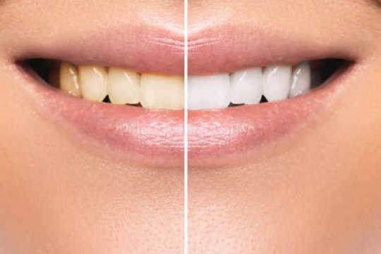 Tooth Whitening – Don’t Gamble With Your Teeth