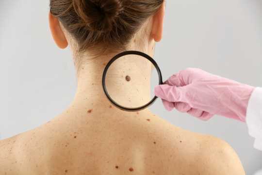 Moles On The Body Largely Determined By Genetics